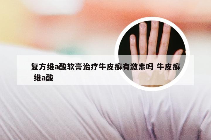 复方维a酸软膏治疗牛皮癣有激素吗 牛皮癣 维a酸