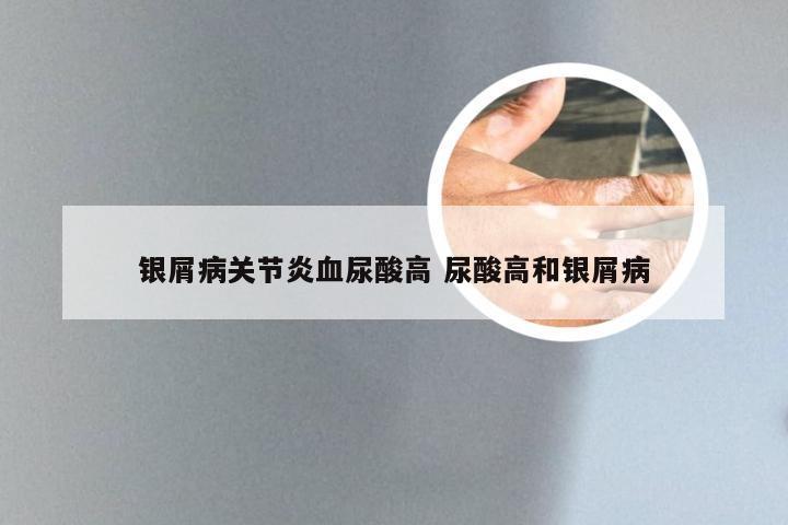银屑病关节炎血尿酸高 尿酸高和银屑病
