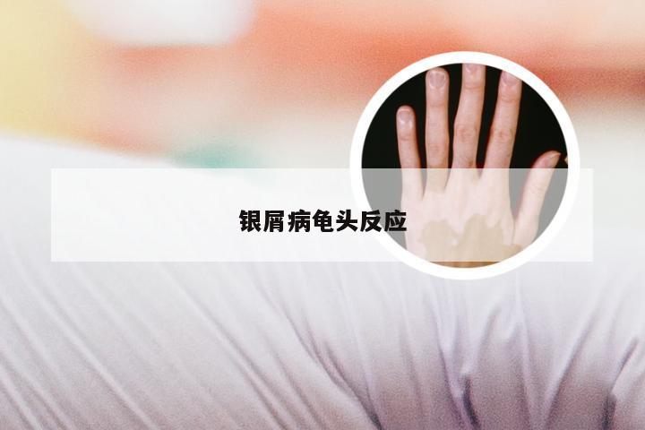 银屑病龟头反应