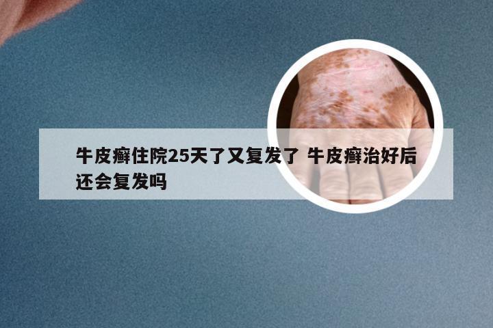 牛皮癣住院25天了又复发了 牛皮癣治好后还会复发吗