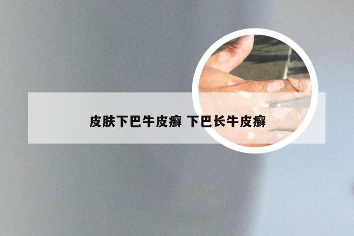 皮肤下巴牛皮癣 下巴长牛皮癣