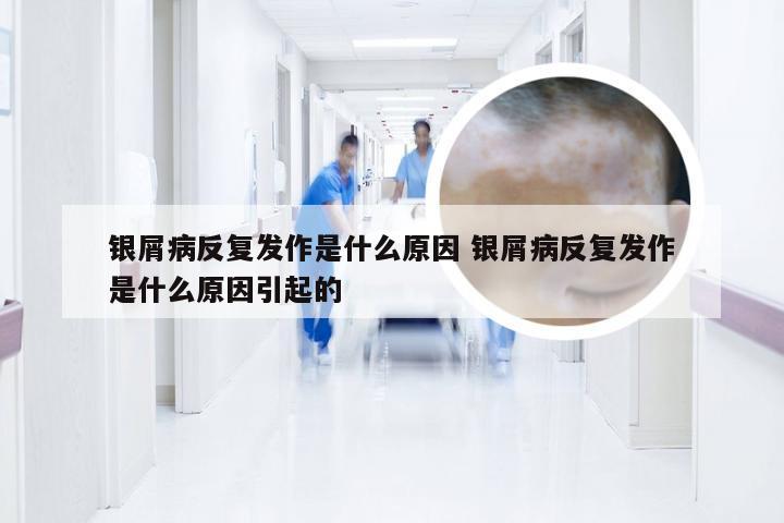 银屑病反复发作是什么原因 银屑病反复发作是什么原因引起的