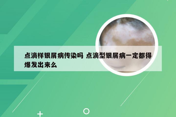 点滴样银屑病传染吗 点滴型银屑病一定都得爆发出来么