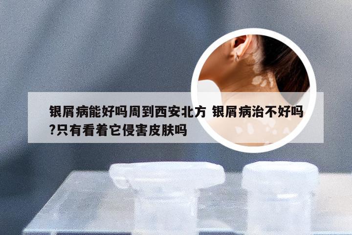 银屑病能好吗周到西安北方 银屑病治不好吗?只有看着它侵害皮肤吗