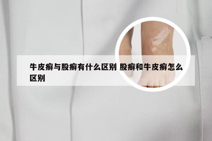 牛皮癣与股癣有什么区别 股癣和牛皮癣怎么区别