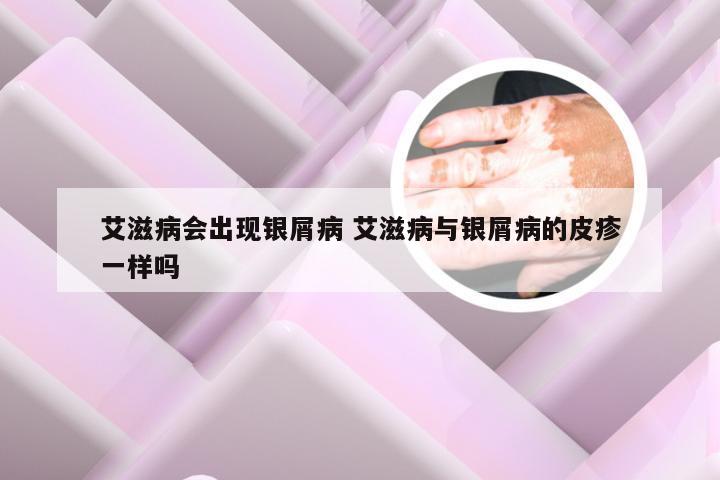 艾滋病会出现银屑病 艾滋病与银屑病的皮疹一样吗