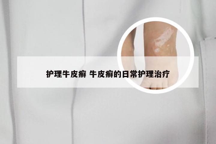 护理牛皮癣 牛皮癣的日常护理治疗