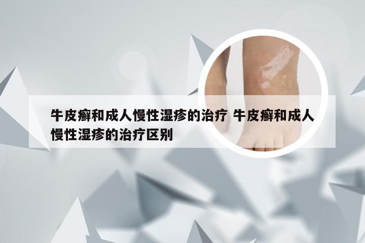 牛皮癣和成人慢性湿疹的治疗 牛皮癣和成人慢性湿疹的治疗区别
