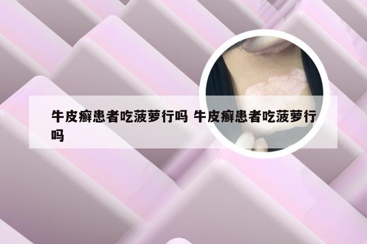 牛皮癣患者吃菠萝行吗 牛皮癣患者吃菠萝行吗