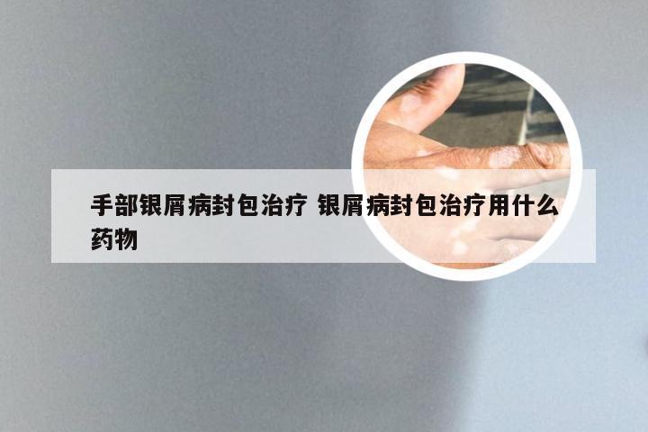 手部银屑病封包治疗 银屑病封包治疗用什么药物