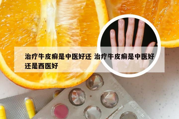 治疗牛皮癣是中医好还 治疗牛皮癣是中医好还是西医好