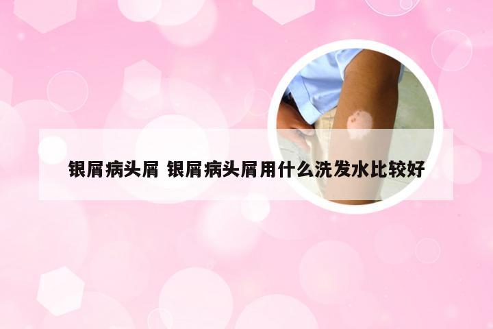 银屑病头屑 银屑病头屑用什么洗发水比较好