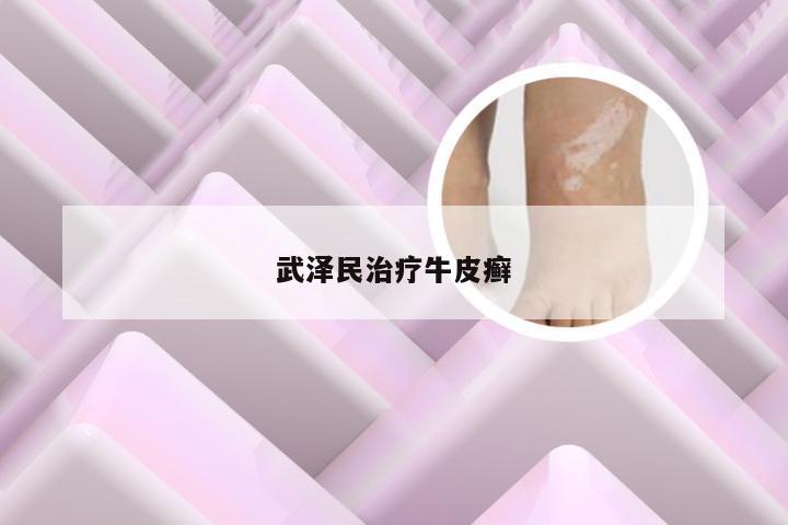武泽民治疗牛皮癣