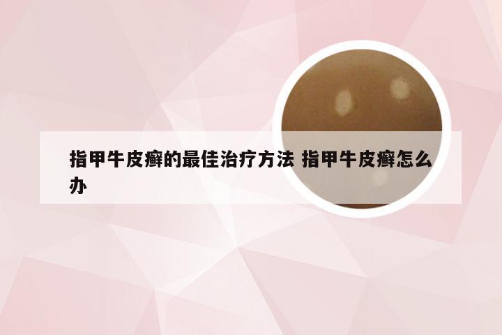 指甲牛皮癣的最佳治疗方法 指甲牛皮癣怎么办