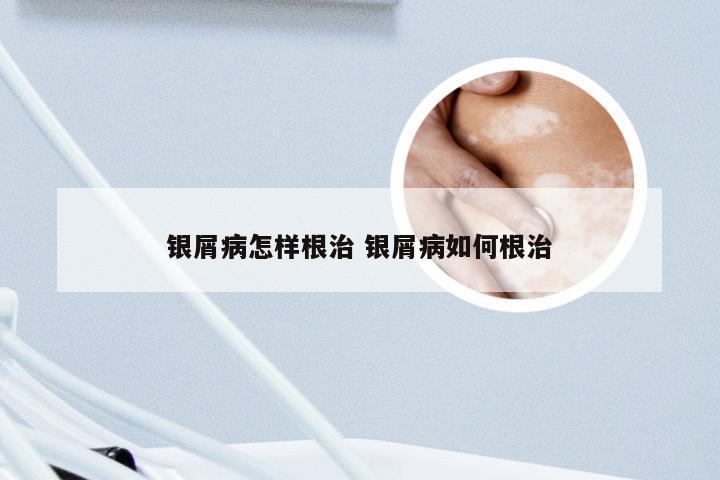 银屑病怎样根治 银屑病如何根治