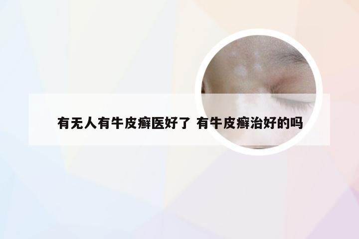 有无人有牛皮癣医好了 有牛皮癣治好的吗