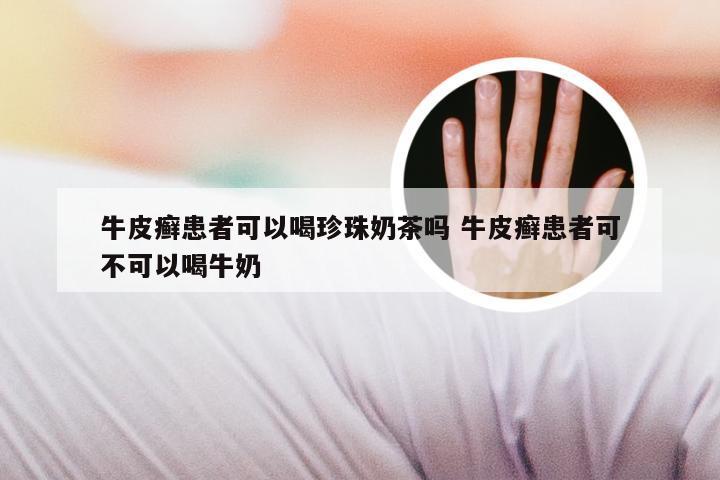 牛皮癣患者可以喝珍珠奶茶吗 牛皮癣患者可不可以喝牛奶