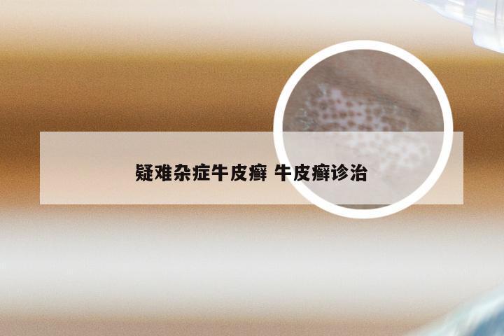疑难杂症牛皮癣 牛皮癣诊治