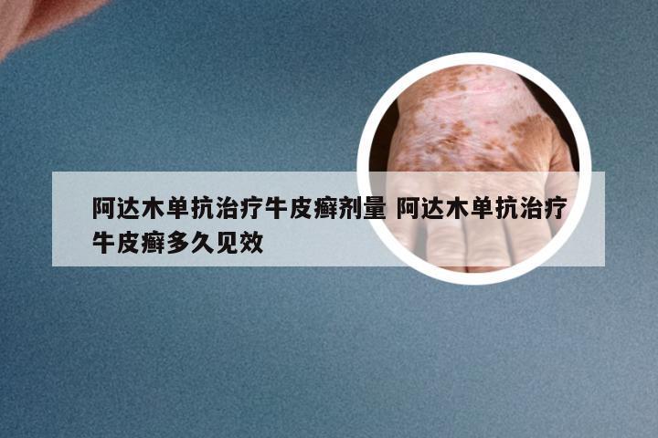 阿达木单抗治疗牛皮癣剂量 阿达木单抗治疗牛皮癣多久见效