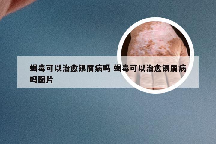 蝎毒可以治愈银屑病吗 蝎毒可以治愈银屑病吗图片