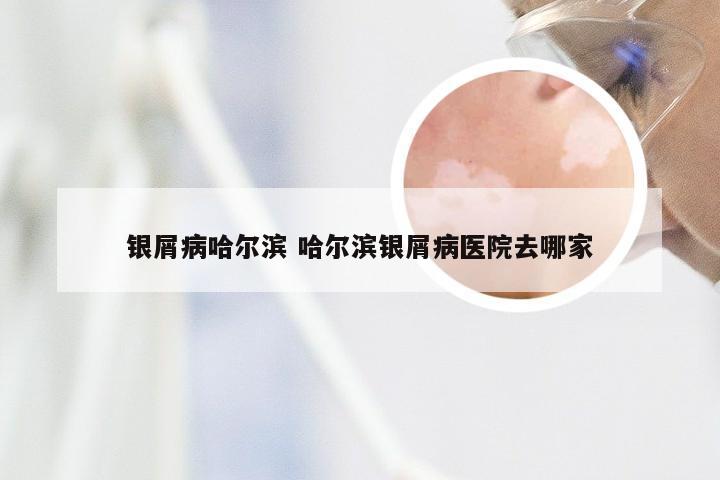 银屑病哈尔滨 哈尔滨银屑病医院去哪家