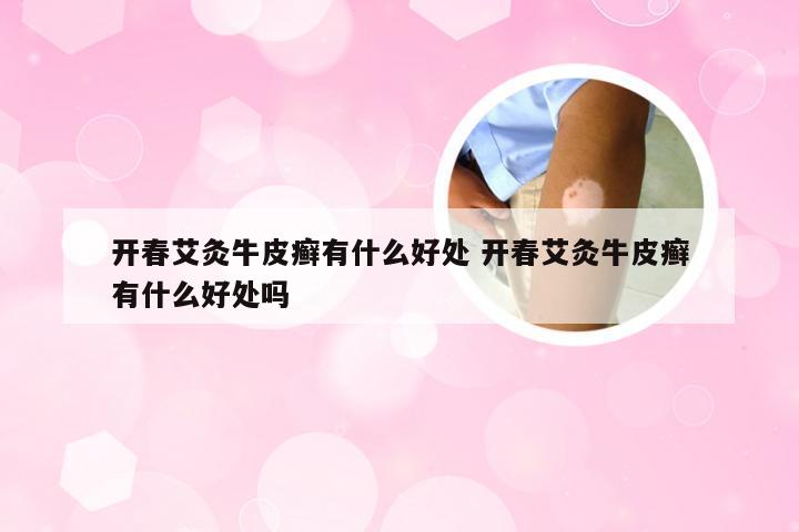 开春艾灸牛皮癣有什么好处 开春艾灸牛皮癣有什么好处吗