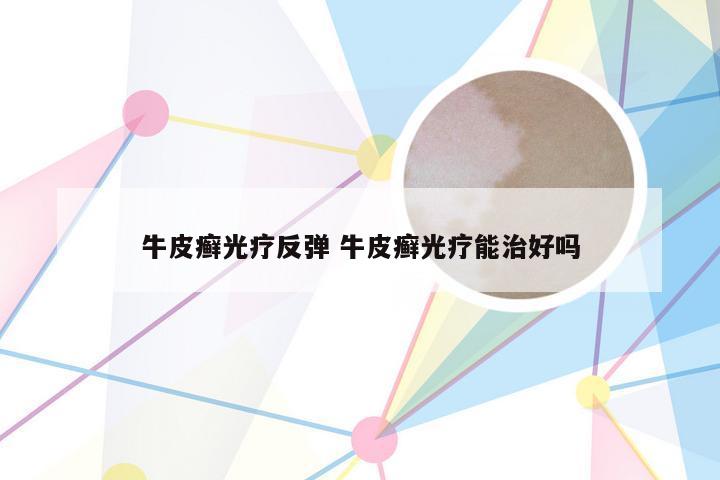 牛皮癣光疗反弹 牛皮癣光疗能治好吗