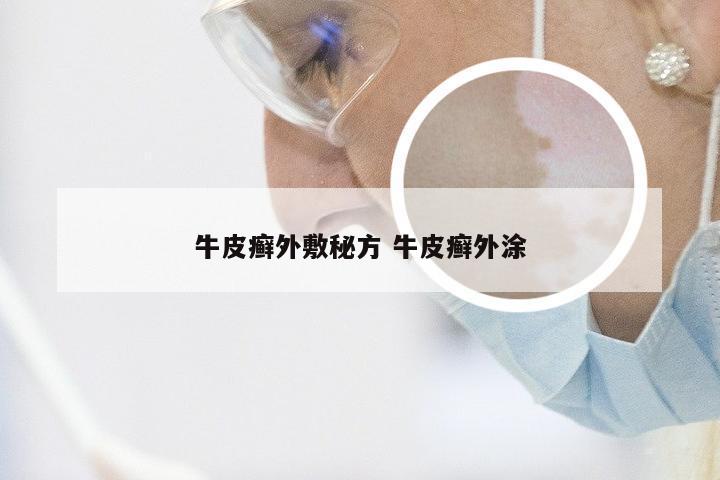 牛皮癣外敷秘方 牛皮癣外涂