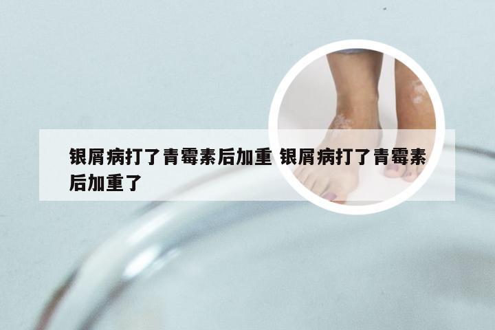 银屑病打了青霉素后加重 银屑病打了青霉素后加重了