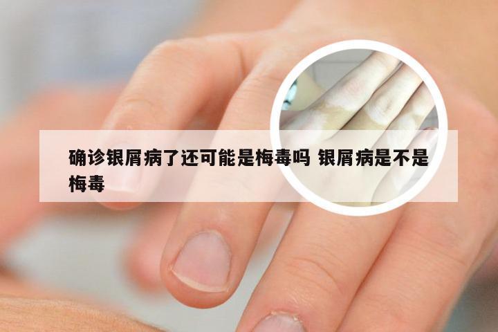 确诊银屑病了还可能是梅毒吗 银屑病是不是梅毒