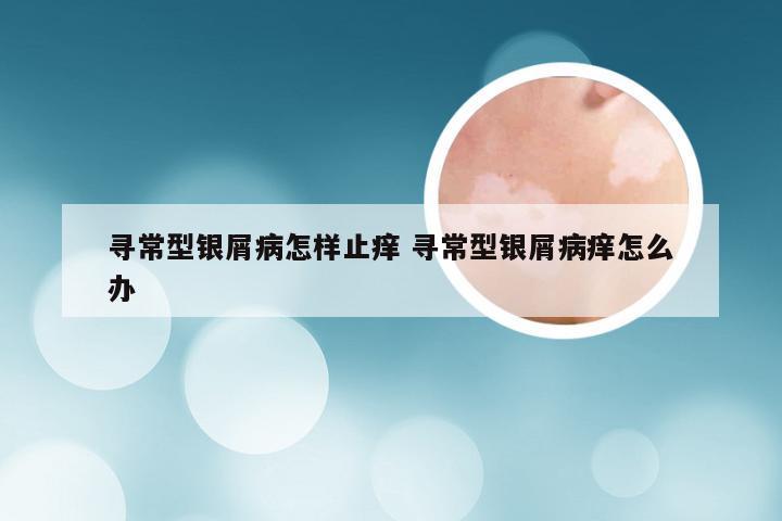 寻常型银屑病怎样止痒 寻常型银屑病痒怎么办