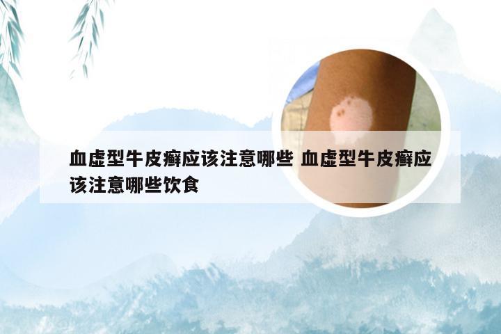 血虚型牛皮癣应该注意哪些 血虚型牛皮癣应该注意哪些饮食
