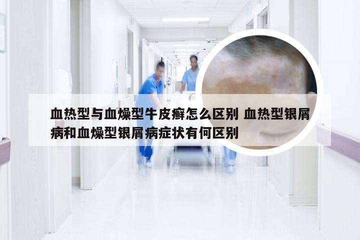 血热型与血燥型牛皮癣怎么区别 血热型银屑病和血燥型银屑病症状有何区别