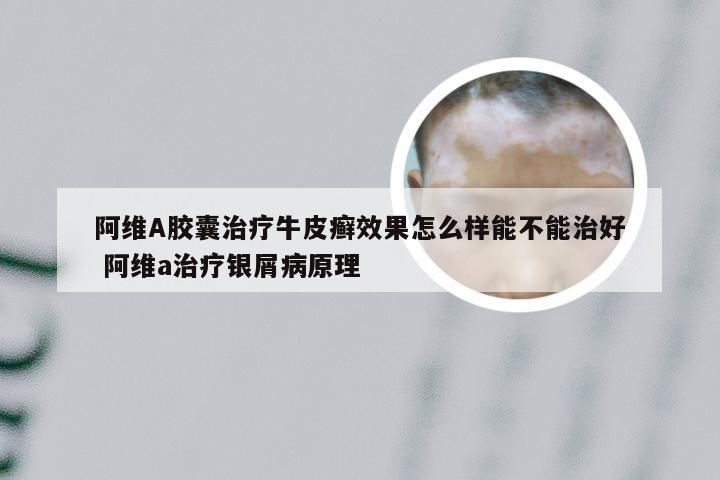 阿维A胶囊治疗牛皮癣效果怎么样能不能治好 阿维a治疗银屑病原理