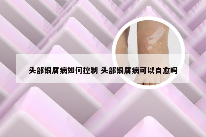 头部银屑病如何控制 头部银屑病可以自愈吗