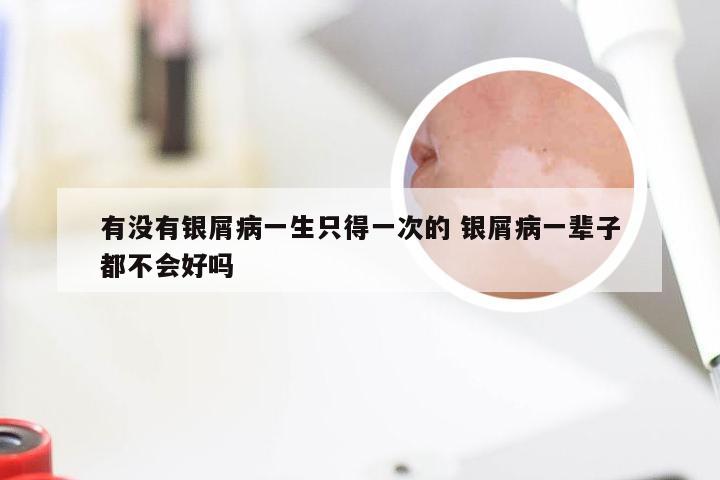 有没有银屑病一生只得一次的 银屑病一辈子都不会好吗