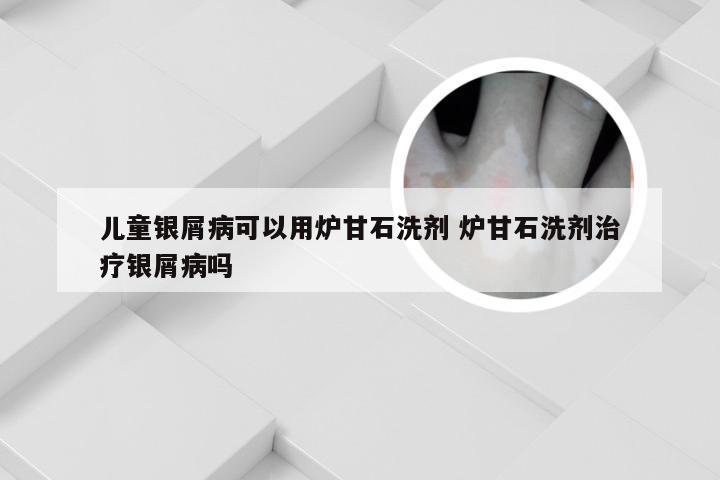 儿童银屑病可以用炉甘石洗剂 炉甘石洗剂治疗银屑病吗