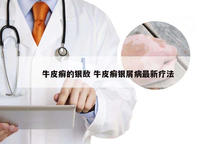 牛皮癣的银敌 牛皮癣银屑病最新疗法