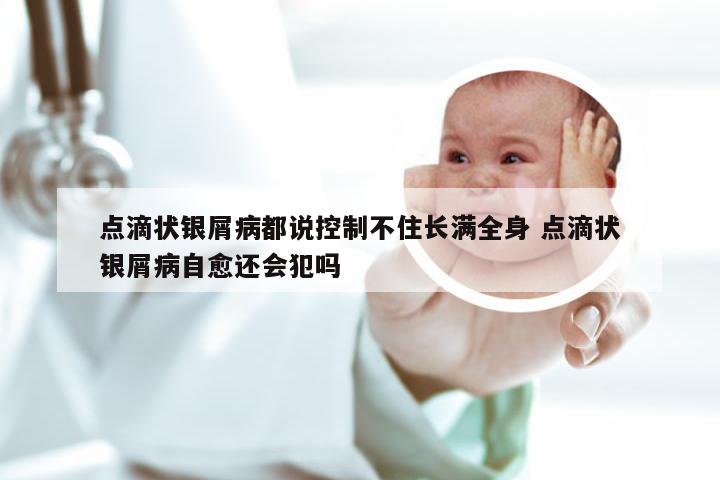 点滴状银屑病都说控制不住长满全身 点滴状银屑病自愈还会犯吗