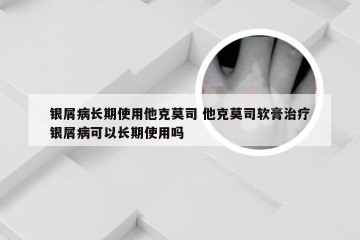 银屑病长期使用他克莫司 他克莫司软膏治疗银屑病可以长期使用吗