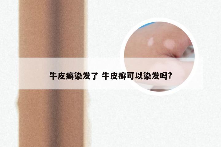 牛皮癣染发了 牛皮癣可以染发吗?