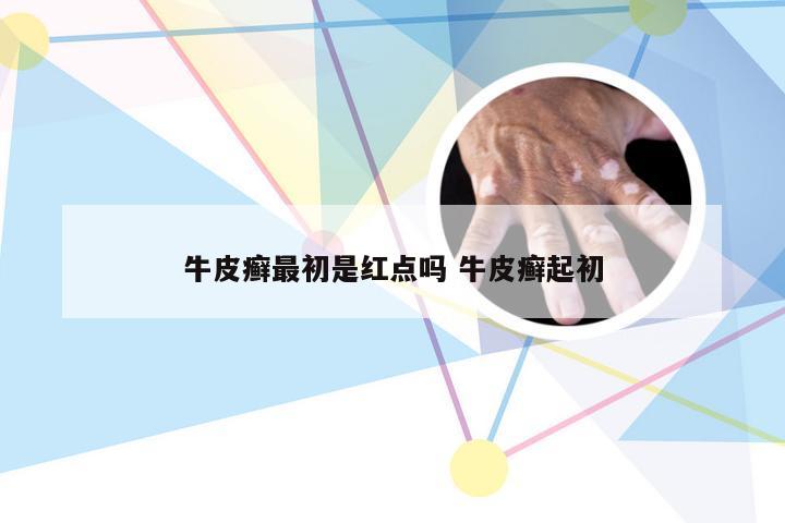 牛皮癣最初是红点吗 牛皮癣起初