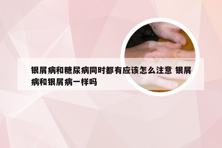银屑病和糖尿病同时都有应该怎么注意 银屑病和银屑病一样吗