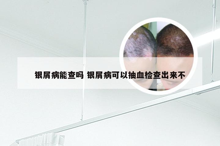 银屑病能查吗 银屑病可以抽血检查出来不