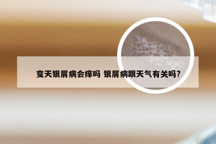 变天银屑病会痒吗 银屑病跟天气有关吗?