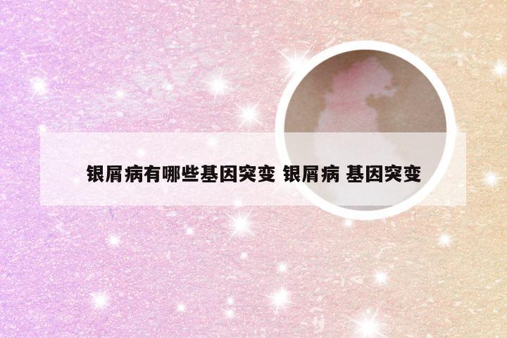 银屑病有哪些基因突变 银屑病 基因突变