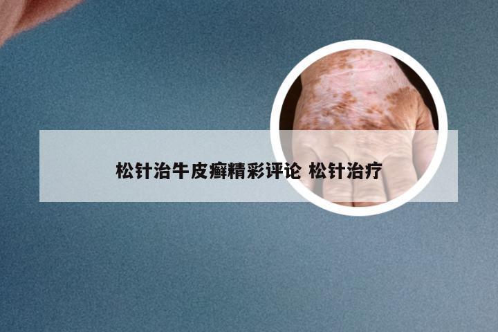 松针治牛皮癣精彩评论 松针治疗