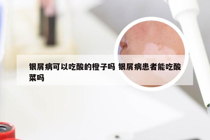 银屑病可以吃酸的橙子吗 银屑病患者能吃酸菜吗