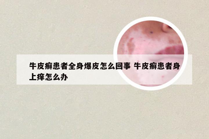 牛皮癣患者全身爆皮怎么回事 牛皮癣患者身上痒怎么办