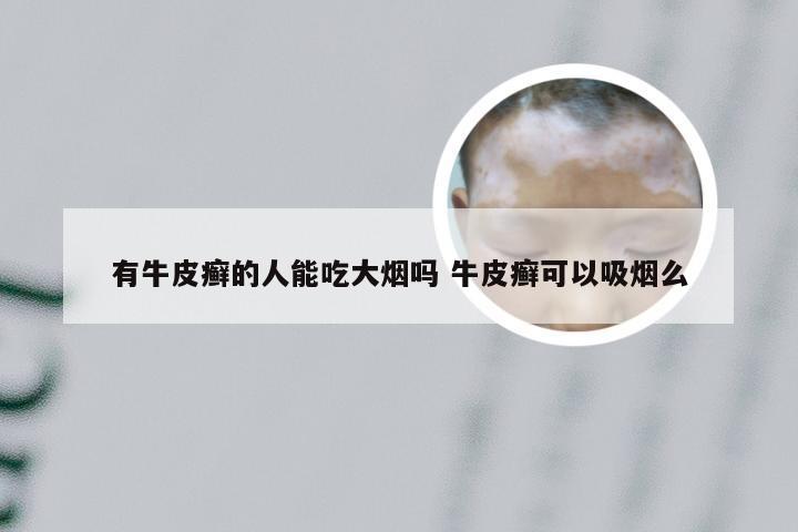 有牛皮癣的人能吃大烟吗 牛皮癣可以吸烟么